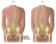 Skolyoz Sırt Ağrısı Belirtileri ve Tedavisi