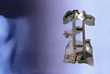 Skolyoz Ortezleri Belirtileri ve Tedavisi