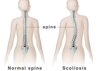 Skolyoz Zararları Nelerdir?