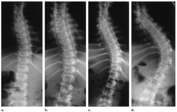 Torakolomber Skolyoz Belirtileri ve Tedavisi
